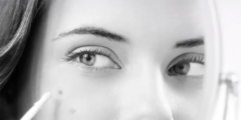 Hiperpigmentáció: mit jelent – És hogyan ismerhetjük fel?