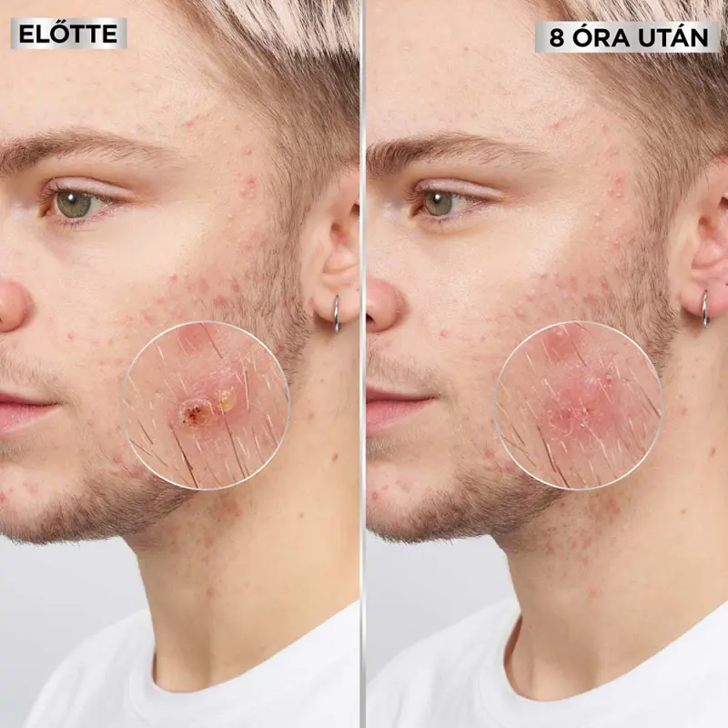 Pure Active Pimple Patch pattanás tapasz BHA-val 8 db