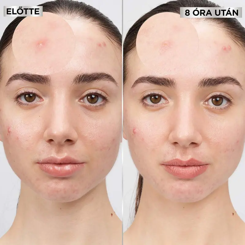 Pure Active Pimple Patch pattanás tapasz BHA-val 8 db