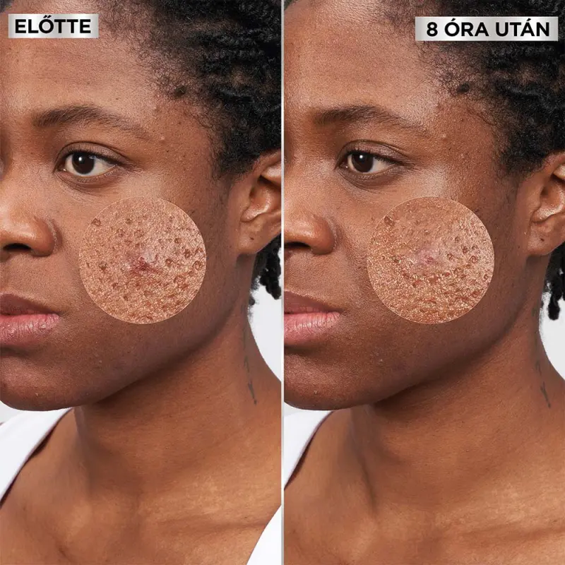 Pure Active Pimple Patch pattanás tapasz BHA-val 8 db