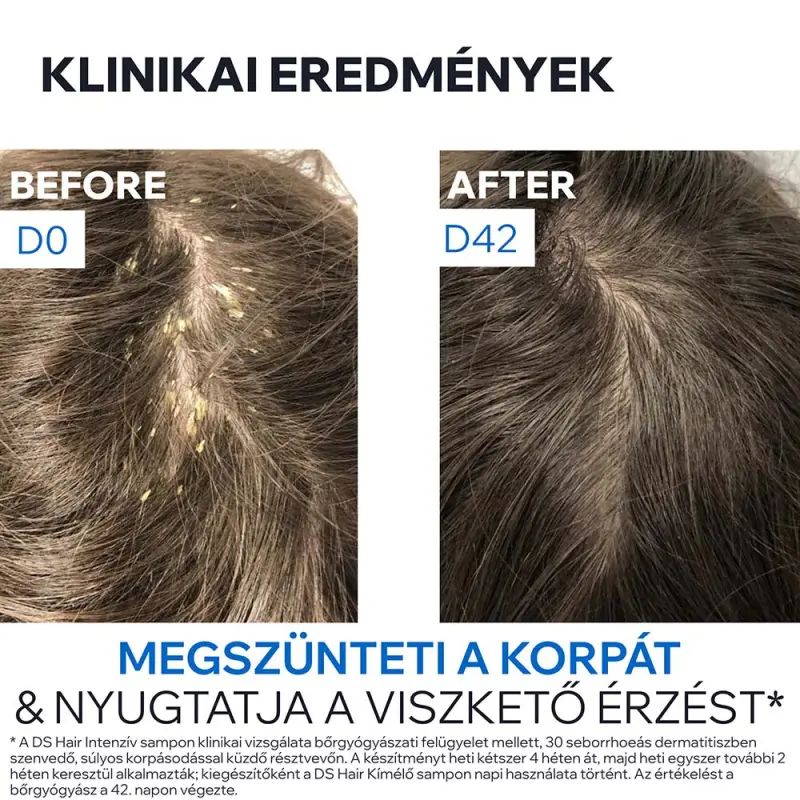 D.S. HAIR Intenzív sampon erősen korpás fejbőrre 150 ml
