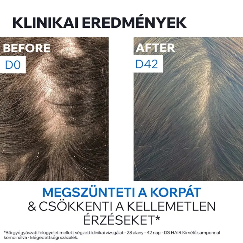 D.S. HAIR Sampon korpás fejbőrre 500 ml